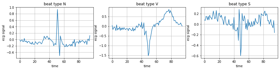 ecg arrhythimas